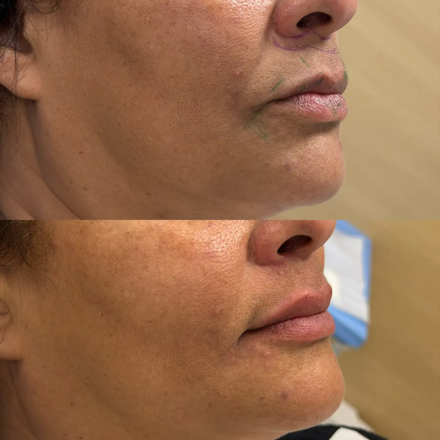 Antes y después: Labios y surco perioral