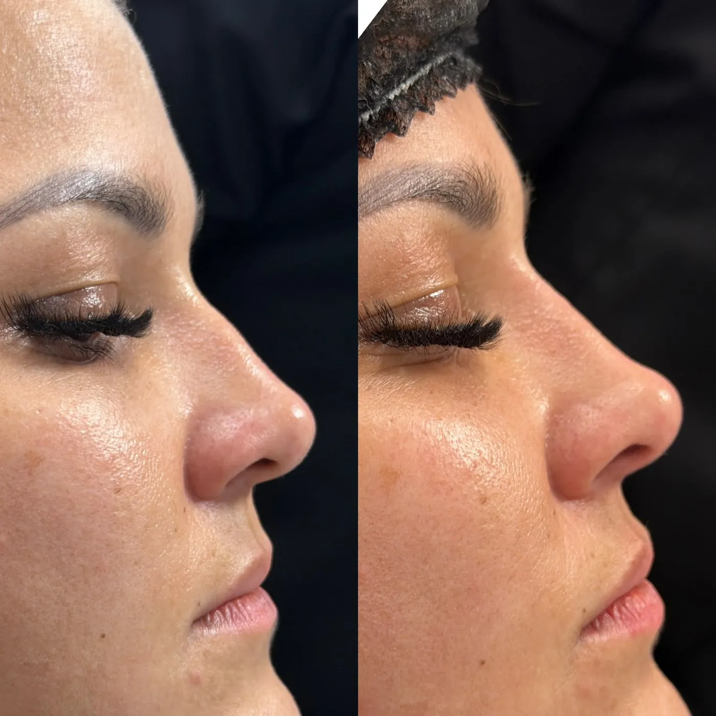 Antes y después: Perfil nasal sin cirugía