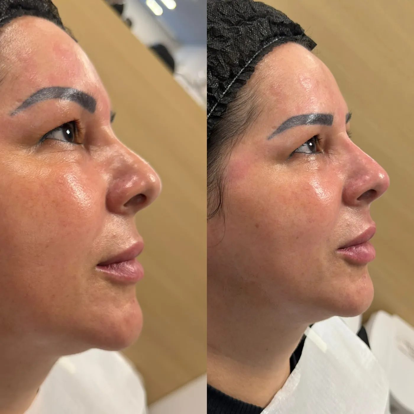 Antes y después: Perfil y contorno
