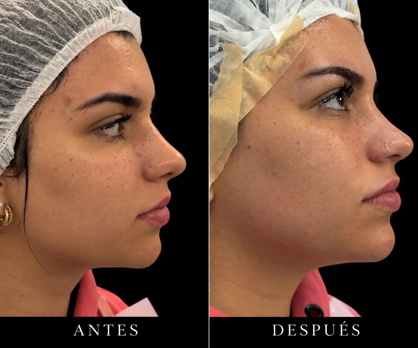 Antes y después: Perfil, mentón y labios
